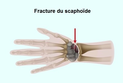 Schéma fracture scaphoïde 